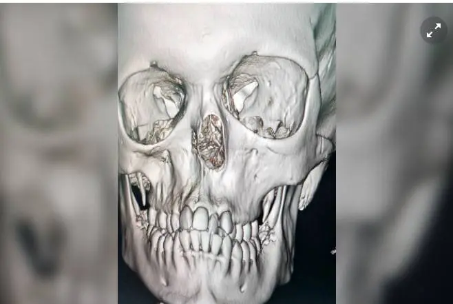 Rossiyada shifokorlar burunsiz tug‘ilgan 14 yoshli qizning burnini qayta tiklashdi