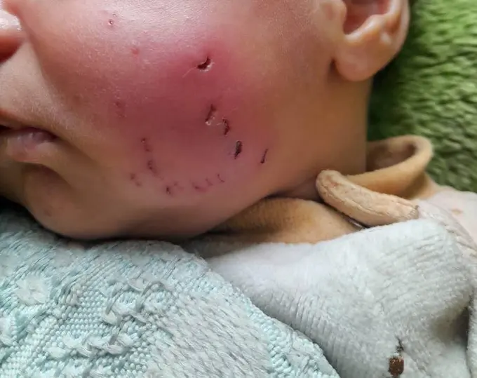 “Uxlasak, tishlaydi”: G‘azo lageridagi bolalarga kalamushlar hujum qilmoqda